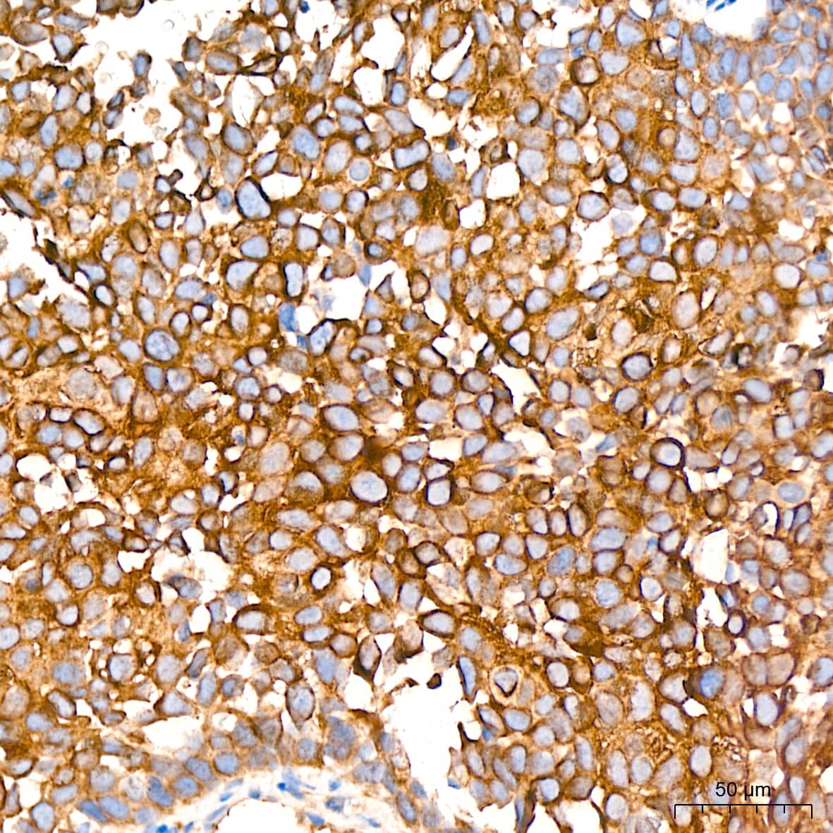 Immunohistochemistry: Activin RIB/ALK-4 Antibody (3U6I8) [NBP3-16106] - Immunohistochemistry analysis of paraffin-embedded Human cervix cancer tissue using Activin RIB/ALK-4 Rabbit mAb at a dilution of 1:200 (40x lens). High pressure antigen retrieval performed with 0.01M Citrate Bufferr (pH 6.0) prior to IHC staining.