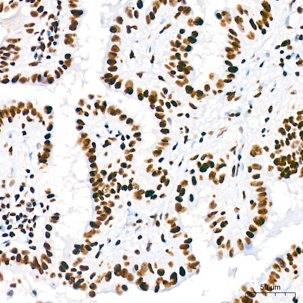 Immunohistochemistry: USP39 Antibody (1S9R9) [NBP3-16119] - Immunohistochemistry analysis of USP39 in paraffin-embedded human thyroid cancer tissue using USP39 Rabbit mAb  at a dilution of 1:200 (40x lens). High pressure antigen retrieval was performed with 0.01 M citrate buffer (pH 6.0) prior to IHC staining.