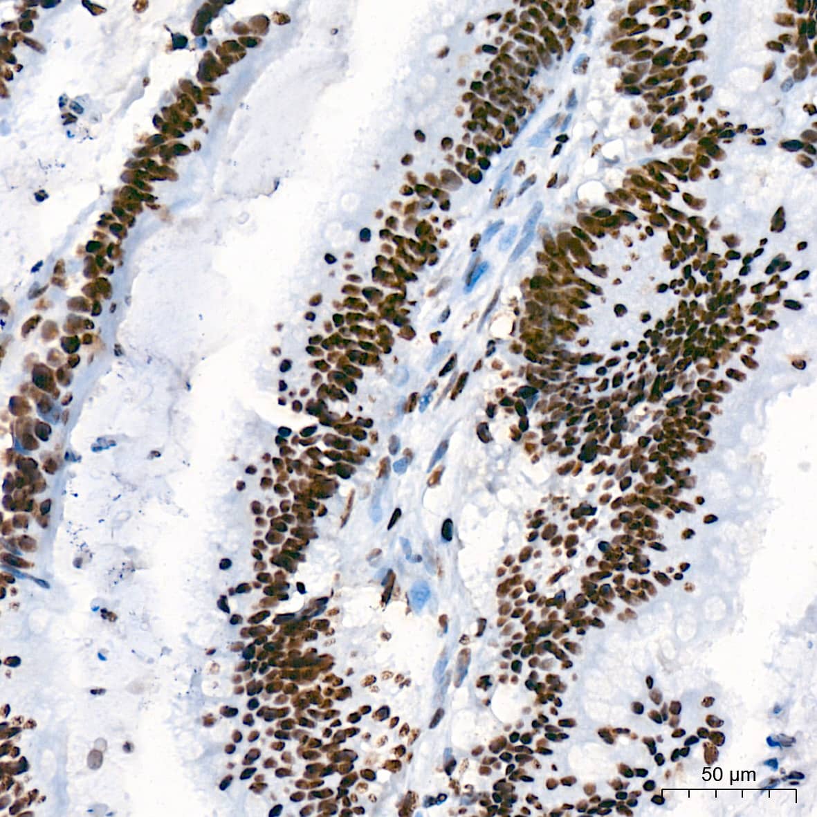 Immunohistochemistry: USP39 Antibody (1S9R9) [NBP3-16119] - Immunohistochemistry analysis of USP39 in paraffin-embedded human colon carcinoma tissue using USP39 Rabbit mAb  at a dilution of 1:200 (40x lens). High pressure antigen retrieval was performed with 0.01 M citrate buffer (pH 6.0) prior to IHC staining.