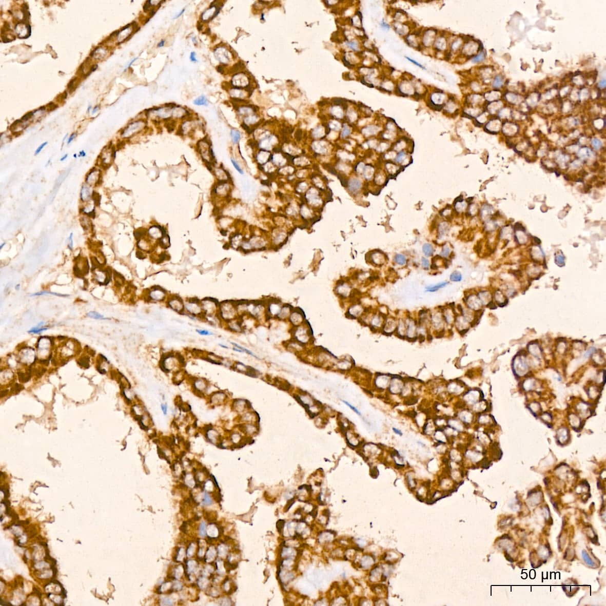 Immunohistochemistry: Peroxiredoxin 3 Antibody (4K7D1) [NBP3-16125] - Immunohistochemistry analysis of paraffin-embedded Human thyroid cancer tissue using Peroxiredoxin 3 Rabbit mAb at a dilution of 1:200 (40x lens). High pressure antigen retrieval performed with 0.01M Citrate Bufferr (pH 6.0) prior to IHC staining.
