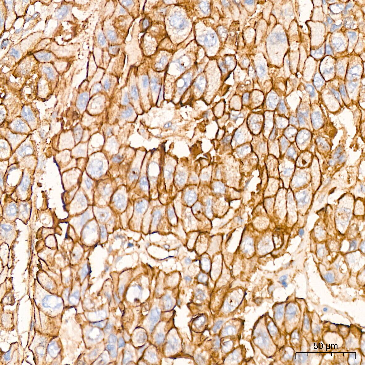 Immunohistochemistry: Alpha Fodrin Antibody (9H5V8) [NBP3-16131] - Immunohistochemistry analysis of Alpha Fodrin in paraffin-embedded human liver cancer tissue using Alpha Fodrin Rabbit mAb  at a dilution of 1:200 (40x lens). High pressure antigen retrieval was performed with 0.01 M citrate buffer (pH 6.0) prior to IHC staining.