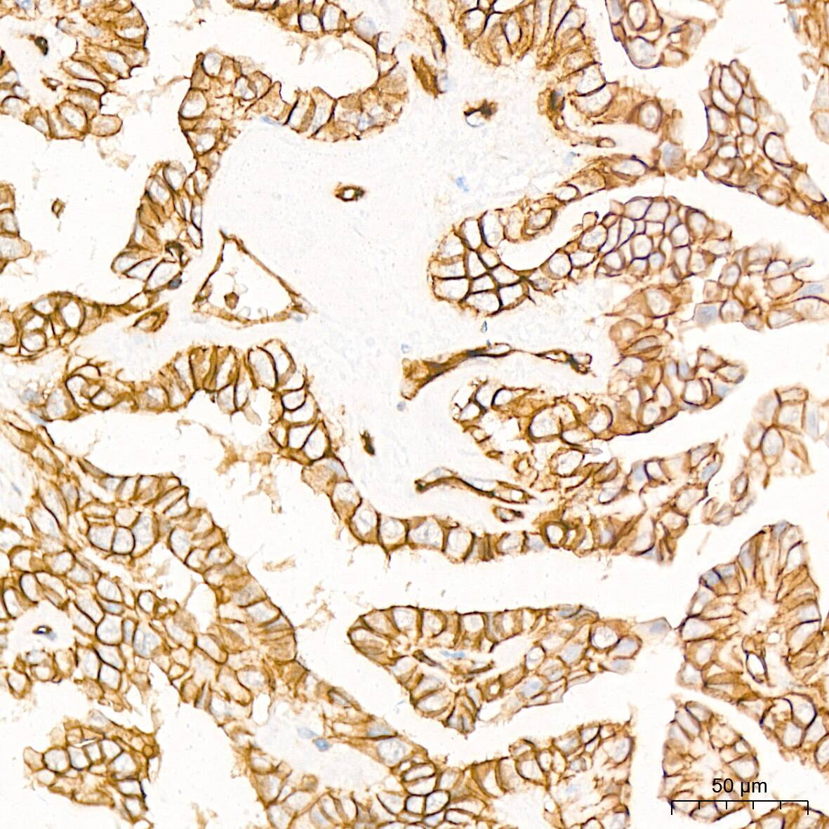 Immunohistochemistry: Alpha Fodrin Antibody (9H5V8) [NBP3-16131] - Immunohistochemistry analysis of Alpha Fodrin in paraffin-embedded human thyroid cancer tissue using Alpha Fodrin Rabbit mAb  at a dilution of 1:200 (40x lens). High pressure antigen retrieval was performed with 0.01 M citrate buffer (pH 6.0) prior to IHC staining.
