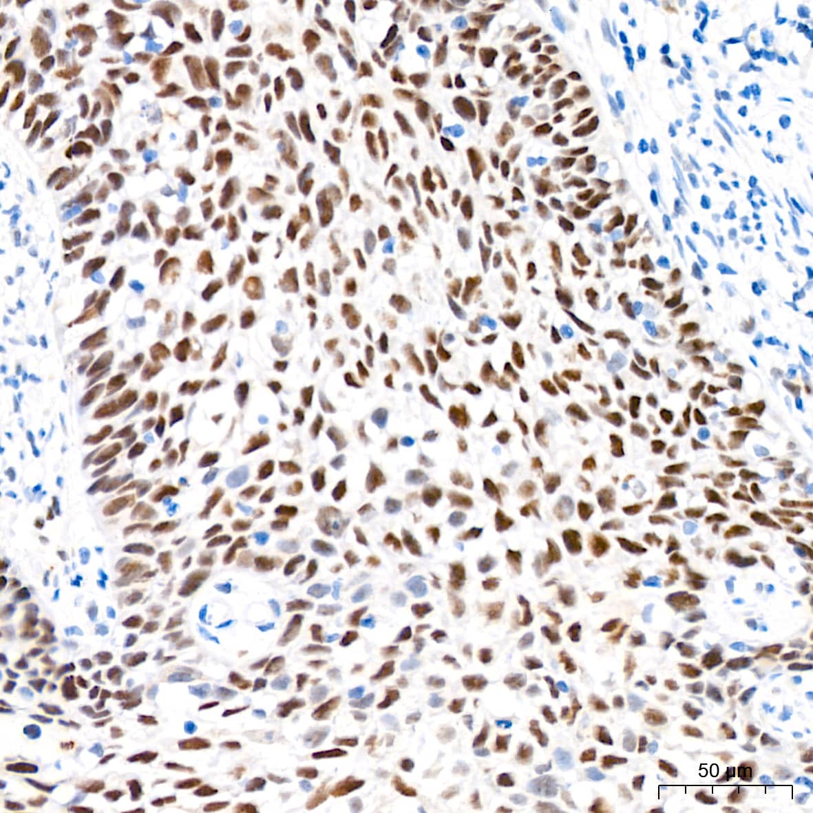 Immunohistochemistry: Nup153 Antibody (3I5V3) [NBP3-16136] - Immunohistochemistry analysis of Nup153 in paraffin-embedded human cervix cancer tissue using Nup153 Rabbit mAb at a dilution of 1:200 (40x lens).High pressure antigen retrieval was performed with 0.01 M citrate buffer (pH 6.0) prior to IHC staining.