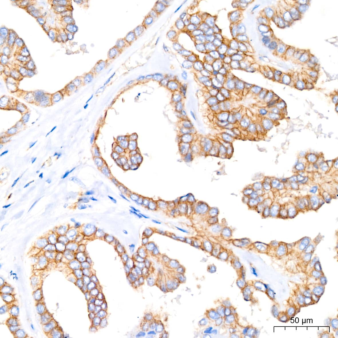 Immunohistochemistry: Flotillin-1 Antibody (8I2S7) [NBP3-16152] - Immunohistochemistry analysis of paraffin-embedded Human thyroid cancer tissue using Flotillin-1 Rabbit mAb at a dilution of 1:200 (40x lens). High pressure antigen retrieval performed with 0.01M Citrate Bufferr (pH 6.0) prior to IHC staining.