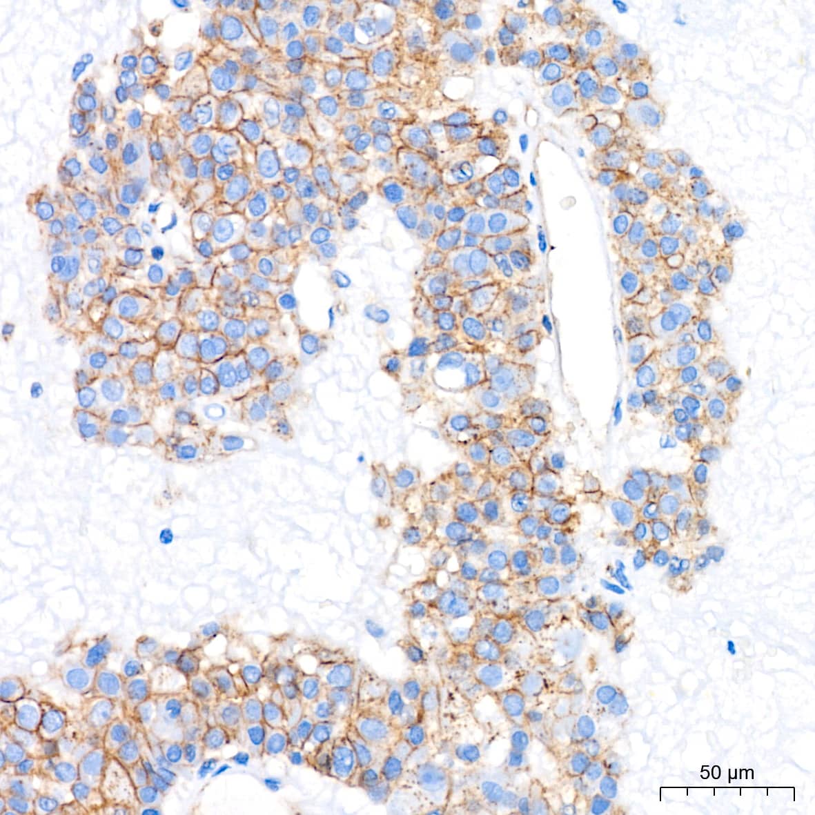 Immunohistochemistry: Flotillin-1 Antibody (8I2S7) [NBP3-16152] - Immunohistochemistry analysis of paraffin-embedded Human liver cancer tissue using Flotillin-1 Rabbit mAb at a dilution of 1:200 (40x lens). High pressure antigen retrieval performed with 0.01M Citrate Bufferr (pH 6.0) prior to IHC staining.