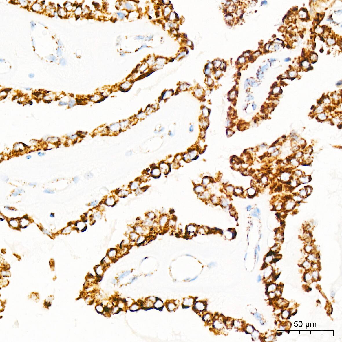 Immunohistochemistry: mtTFA Antibody (4H2M9) [NBP3-16154] - Immunohistochemistry analysis of paraffin-embedded Human thyroid cancer tissue using mtTFA Rabbit mAb at a dilution of 1:1000 (40x lens). High pressure antigen retrieval was performed with 0.01 M citrate buffer (pH 6.0) prior to IHC staining.