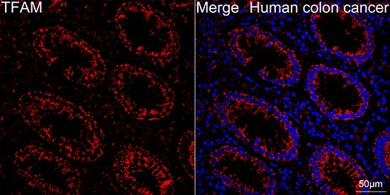Immunocytochemistry/ Immunofluorescence: mtTFA Antibody (4H2M9) [NBP3-16154] - Confocal imaging of paraffin-embedded Human colon cancer tissue using mtTFA Rabbit mAb followed by a further incubation with Cy3 Goat Anti-Rabbit IgG (H+L) . DAPI was used for nuclear staining (Blue). Objective: 40x. Perform high pressure antigen retrieval with 0.01 M citrate buffer (pH 6.0) prior to IF staining.
