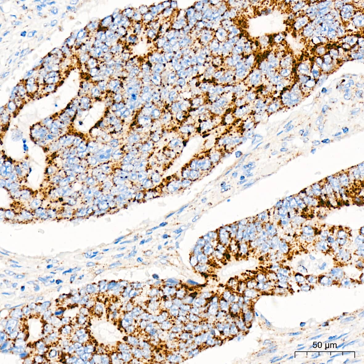 Immunohistochemistry: mtTFA Antibody (4H2M9) [mtTFA] - Immunohistochemistry analysis of paraffin-embedded Human colon carcinoma tissue using mtTFA Rabbit mAb  at a dilution of 1:1000 (40x lens). High pressure antigen retrieval was performed with 0.01 M citrate buffer (pH 6.0) prior to IHC staining.