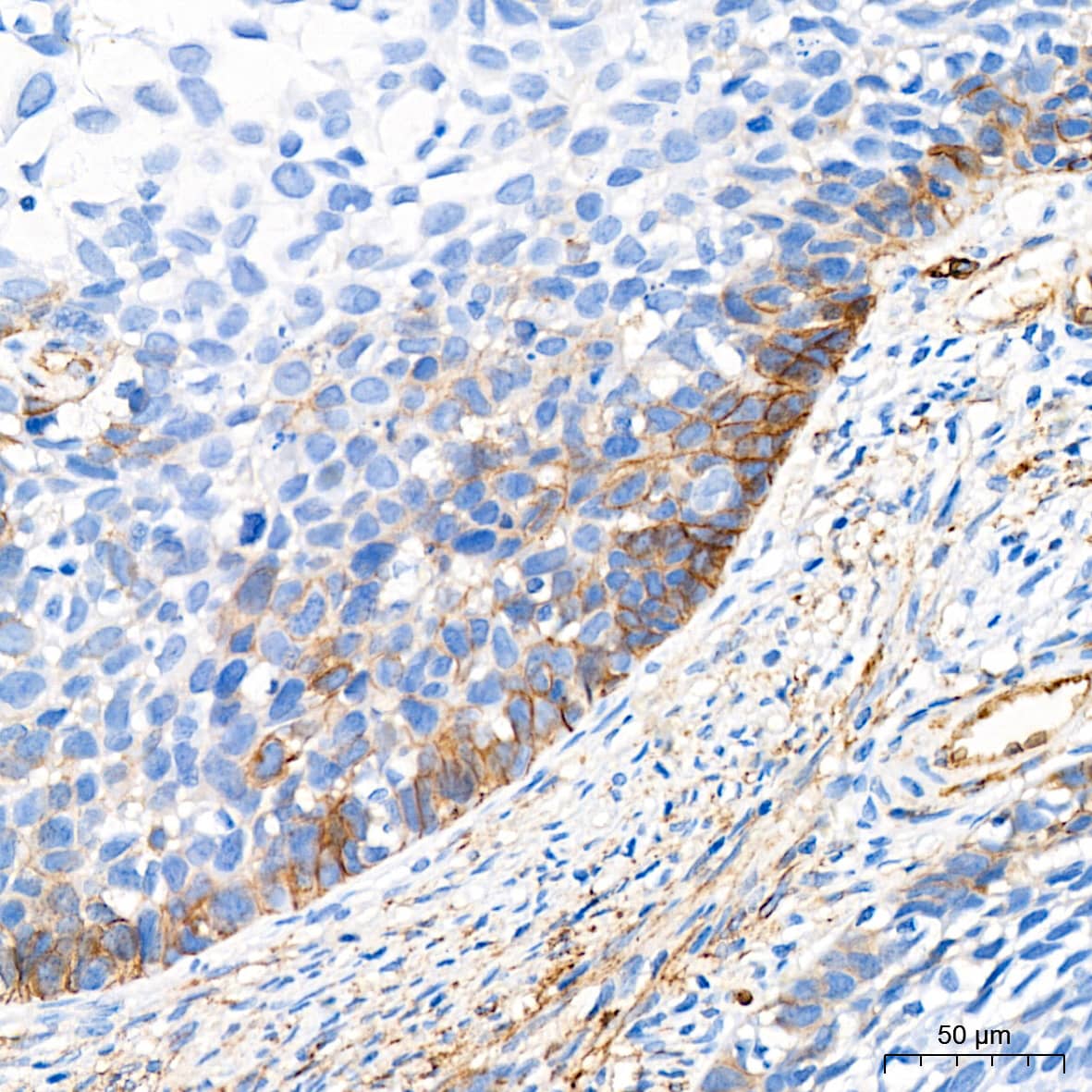 Immunohistochemistry: Cadherin-13 Antibody (4Z8D1) [NBP3-16158] - Immunohistochemistry analysis of Cadherin-13 in paraffin-embedded human cervix cancer tissue using Cadherin-13 Rabbit mAb  at a dilution of 1:200 (40x lens).High pressure antigen retrieval was performed with 0.01 M citrate buffer (pH 6.0) prior to IHC staining.