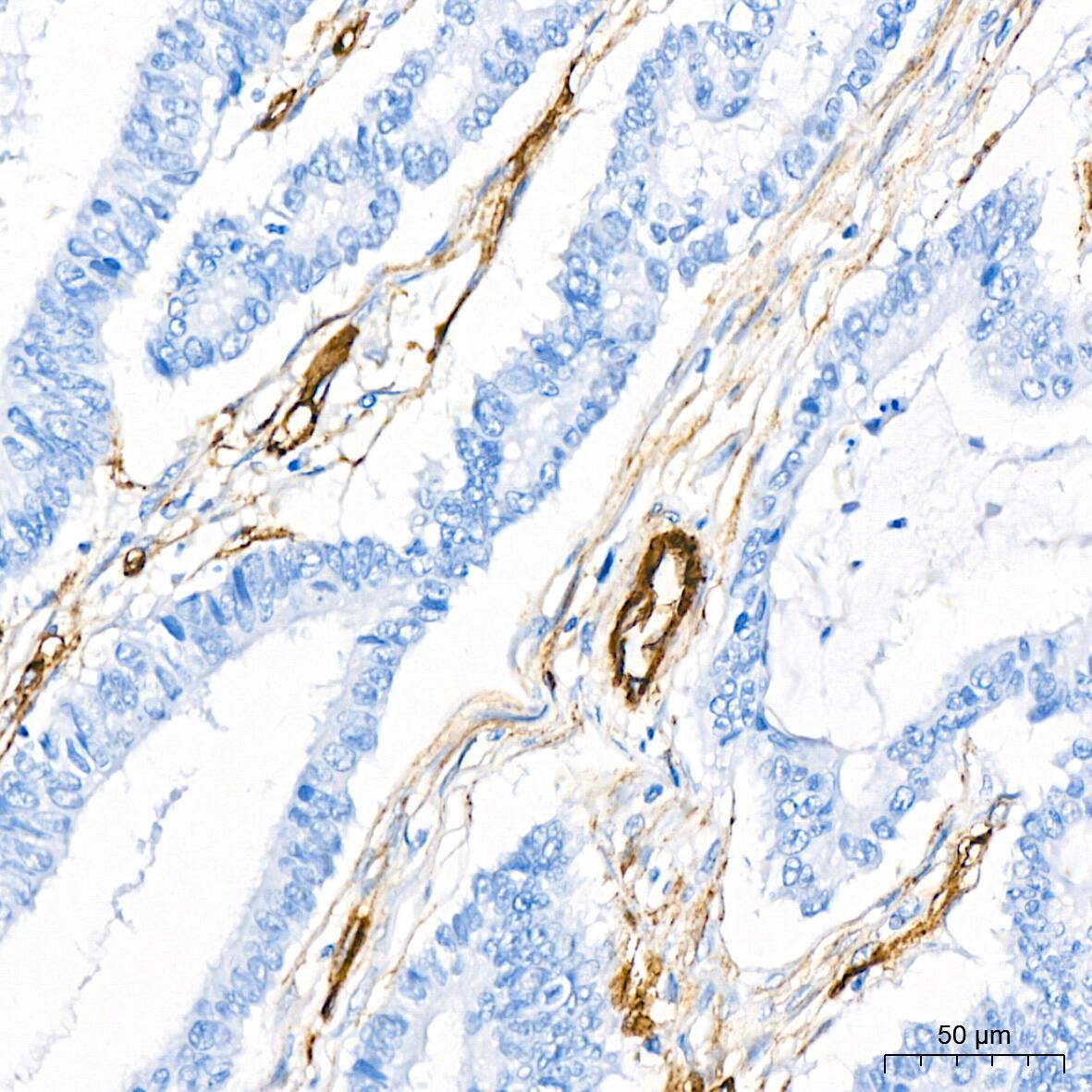 Immunohistochemistry: Cadherin-13 Antibody (4Z8D1) [NBP3-16158] - Immunohistochemistry analysis of Cadherin-13 in paraffin-embedded human colon carcinoma tissue using Cadherin-13 Rabbit mAb  at a dilution of 1:200 (40x lens).High pressure antigen retrieval was performed with 0.01 M citrate buffer (pH 6.0) prior to IHC staining.