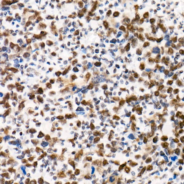 Immunohistochemistry: SNF5 Antibody (9A9G0) [NBP3-16159] - Immunohistochemistry analysis of paraffin-embedded Human undifferentiated carcinoma of esophagus using [KO Validated] SNF5 Rabbit mAb at dilution of 1:100 (40x lens). High pressure antigen retrieval performed with 0.01M Tris/EDTA Buffer (pH 9.0) prior to IHC staining.