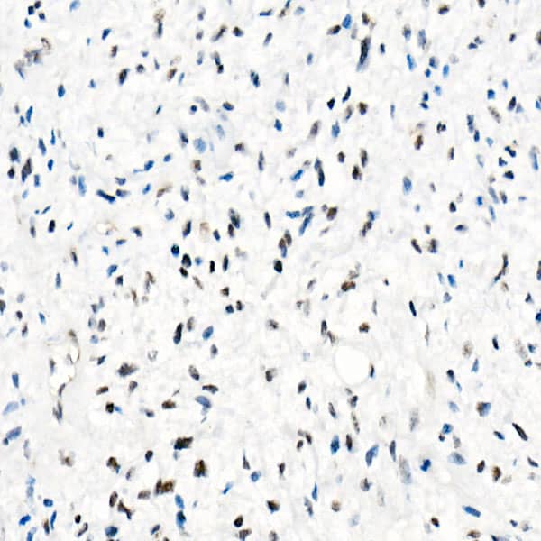 Immunohistochemistry: SNF5 Antibody (9A9G0) [NBP3-16159] - Immunohistochemistry analysis of paraffin-embedded Human epithelioid sarcoma (ini-1 deletion) using [KO Validated] SNF5 Rabbit mAb at dilution of 1:100 (40x lens). High pressure antigen retrieval performed with 0.01M Tris/EDTA Buffer (pH 9.0) prior to IHC staining.