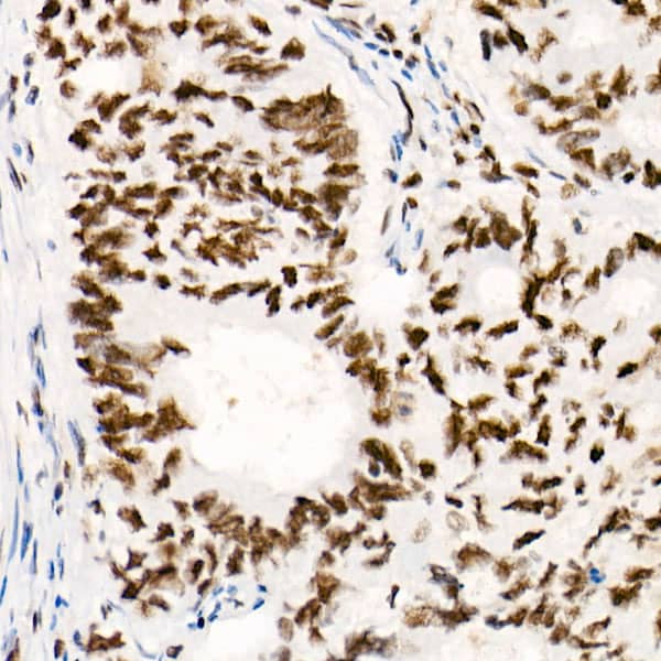 Immunohistochemistry: SNF5 Antibody (9A9G0) [SNF5] - Immunohistochemistry analysis of paraffin-embedded Human colon carcinoma using [KO Validated] SNF5 Rabbit mAb  at dilution of 1:100 (40x lens). High pressure antigen retrieval performed with 0.01M Tris/EDTA Buffer (pH 9.0) prior to IHC staining.