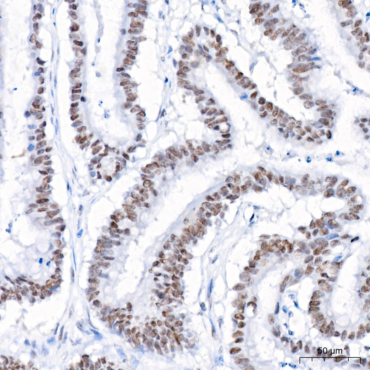 Immunohistochemistry: USP7 Antibody (3J7G1) [NBP3-16188] - Immunohistochemistry analysis of paraffin-embedded Human colon carcinoma tissue using USP7 Rabbit mAb at a dilution of 1:200 (40x lens). High pressure antigen retrieval performed with 0.01M Citrate Bufferr (pH 6.0) prior to IHC staining.