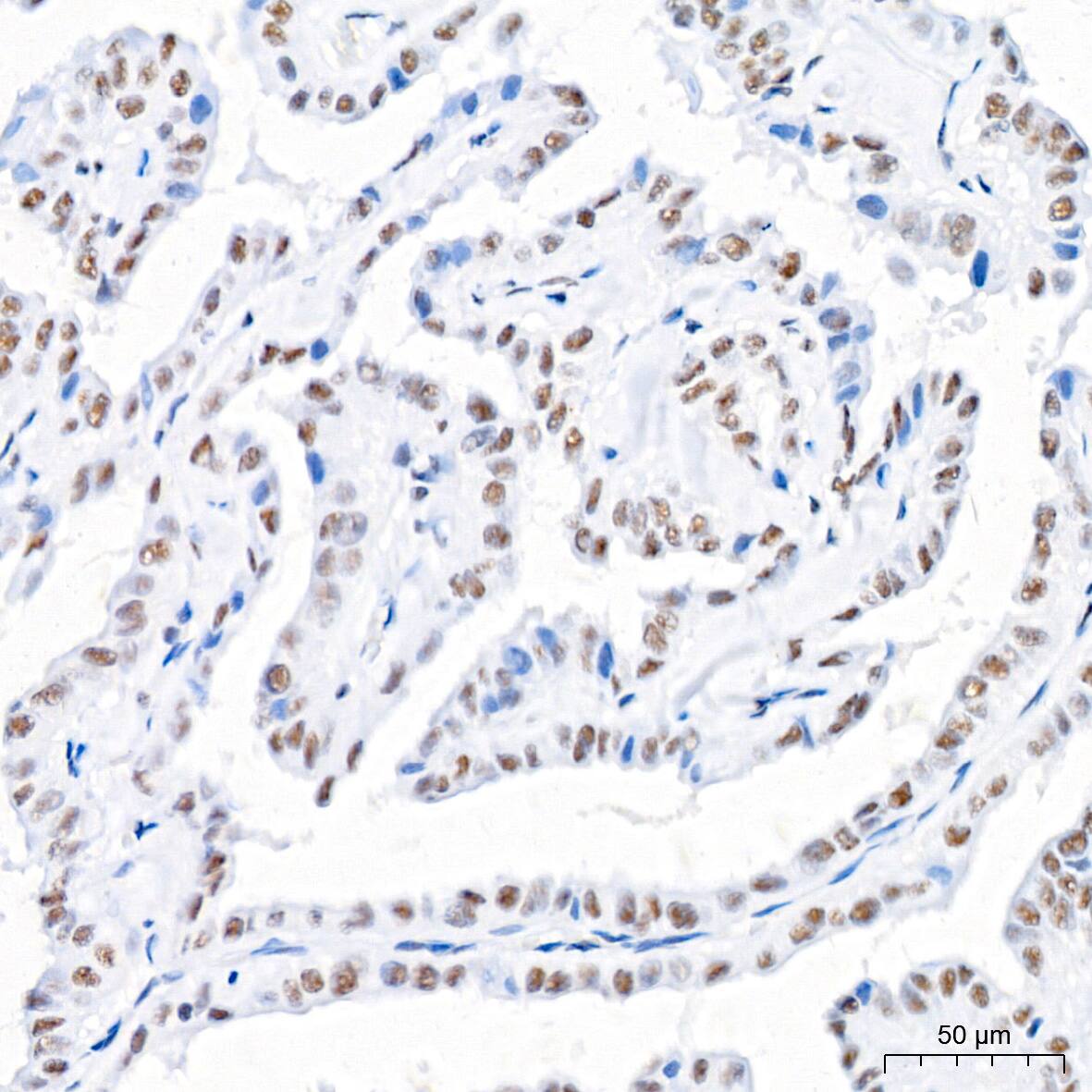 Immunohistochemistry: USP7 Antibody (3J7G1) [NBP3-16188] - Immunohistochemistry analysis of paraffin-embedded Human thyroid cancer tissue using USP7 Rabbit mAb at a dilution of 1:200 (40x lens). High pressure antigen retrieval performed with 0.01M Citrate Bufferr (pH 6.0) prior to IHC staining.