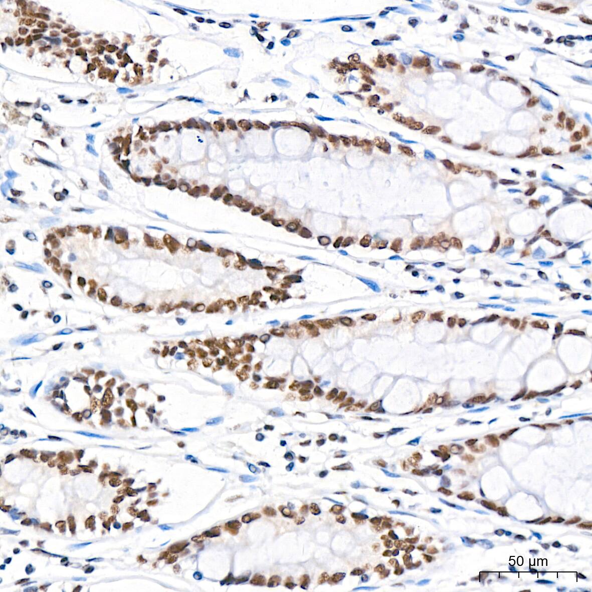 Immunohistochemistry: USP7 Antibody (3J7G1) [USP7] - Immunohistochemistry analysis of paraffin-embedded Human colon tissue using USP7 Rabbit mAb  at a dilution of 1:200 (40x lens). High pressure antigen retrieval performed with 0.01M Citrate Bufferr (pH 6.0) prior to IHC staining.