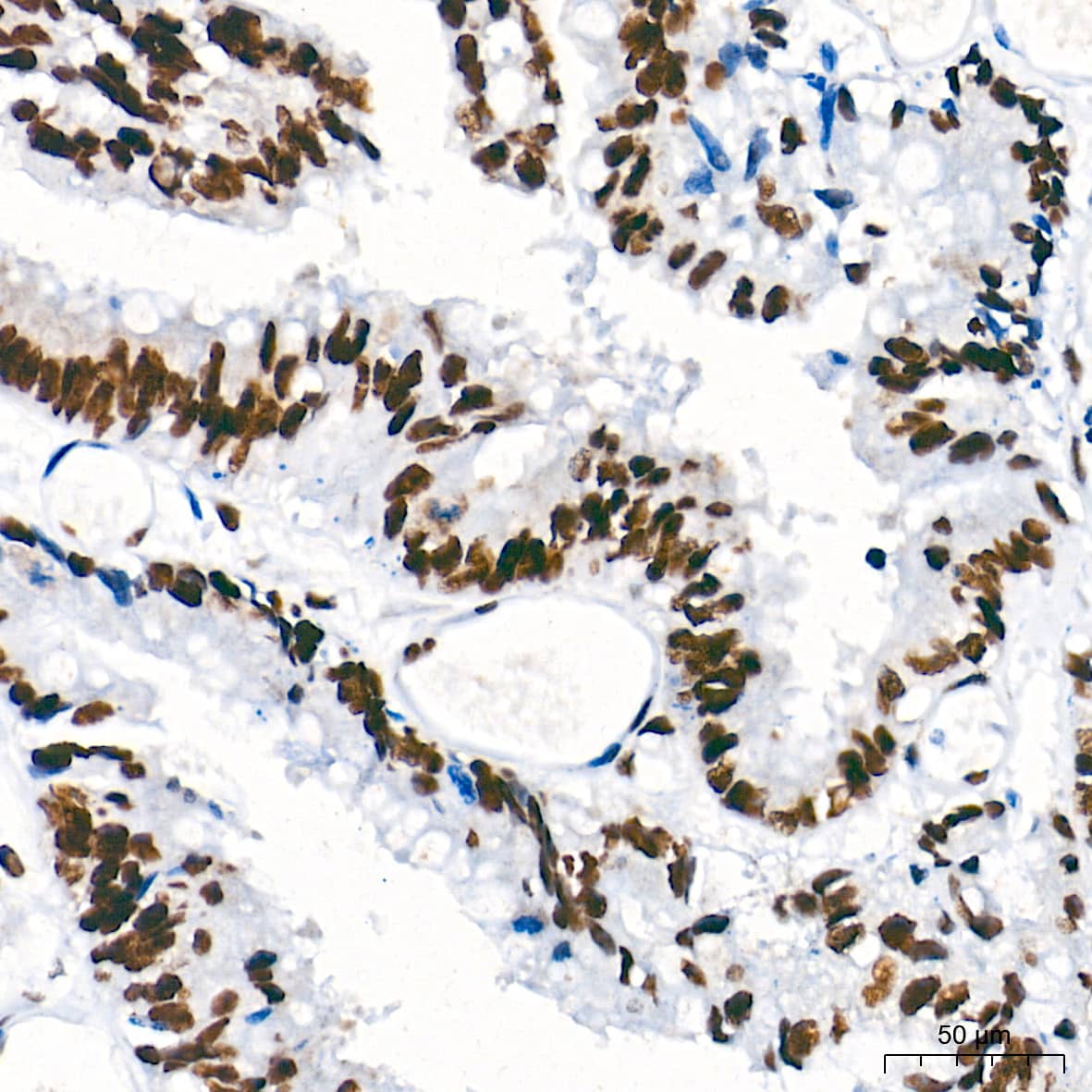 Immunohistochemistry: PTBP1 Antibody (9M6A8) [PTBP1] - Immunohistochemistry analysis of paraffin-embedded Human colon carcinoma tissue using PTBP1 Rabbit mAb  at a dilution of 1:500 (40x lens). High pressure antigen retrieval performed with 0.01M Tris-EDTA Buffer (pH 9.0) prior to IHC staining.