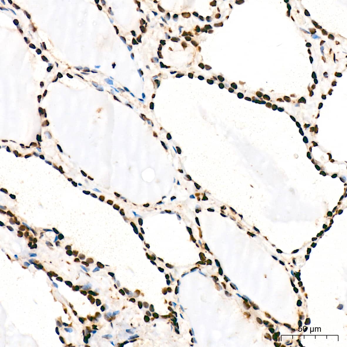 Immunohistochemistry: ANP32B Antibody (4A8E5) [NBP3-16199] - Immunohistochemistry analysis of ANP32B in paraffin-embedded human thyroid tissue using ANP32B Rabbit mAb  at a dilution of 1:200 (40x lens). High pressure antigen retrieval was performed with 0.01 M citrate buffer (pH 6.0) prior to IHC staining.