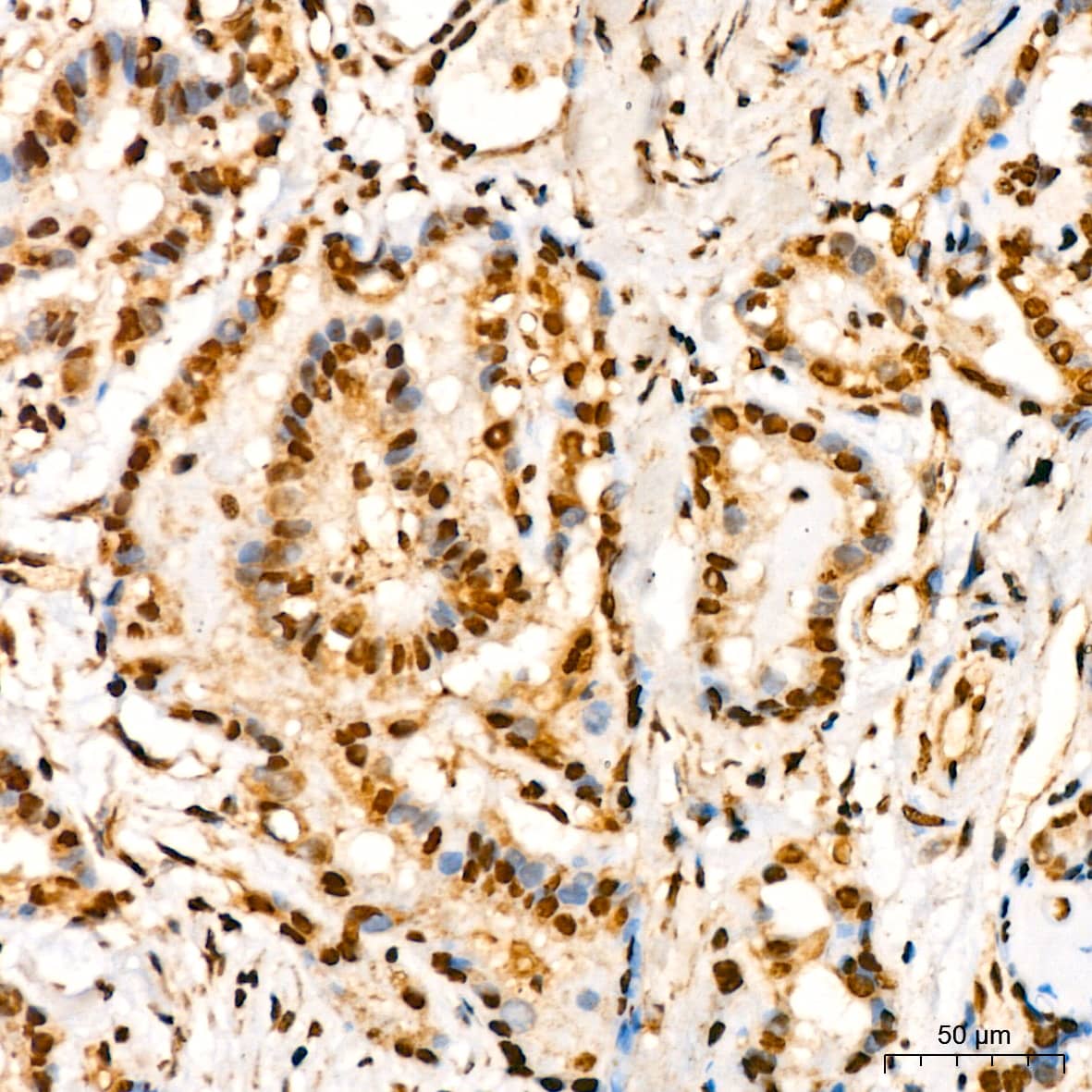 Immunohistochemistry: YB1 Antibody (9J7M4) [NBP3-16213] - Immunohistochemistry analysis of paraffin-embedded Human thyroid cancer using YB1 Rabbit mAb at dilution of 1:200 (40x lens). High pressure antigen retrieval performed with 0.01M Citrate Bufferr (pH 6.0) prior to IHC staining.