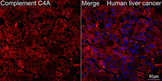 Immunocytochemistry/ Immunofluorescence: Complement C4a Antibody (4C3F2) [NBP3-16217] - Confocal imaging of paraffin-embedded Human liver cancer tissue  using Complement C4a Rabbit mAb  followed by a further incubation with Cy3 Goat Anti-Rabbit IgG (H+L)  . DAPI was used for nuclear staining (Blue). Objective: 40x. Perform high pressure antigen retrieval with 0.01 M citrate buffer (pH 6.0) prior to IF staining.