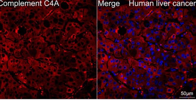 Immunohistochemistry: Complement C4a Antibody (4C3F2) [NBP3-16217] -Human liver cancer tissue using Complement C4A Rabbit mAb (dilution 1:100) followed by a further incubation with Cy3 Goat Anti-Rabbit IgG (H+L) ( dilution 1:500) (Red). DAPI was used for nuclear staining (Blue). Objective: 40x. Perform high pressure antigen retrieval with 0.01 M citrate buffer (pH 6.0) prior to IF staining.