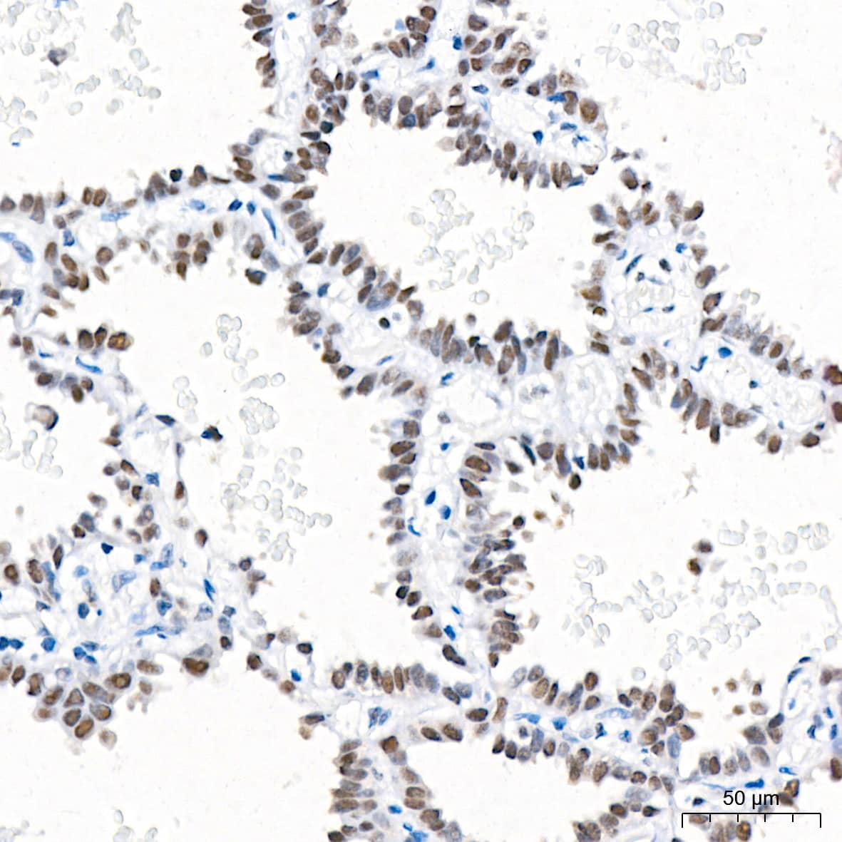 Immunohistochemistry: RCOR1/CoREST Antibody (9B3R7) [NBP3-16225] - Immunohistochemistry analysis of paraffin-embedded Human lung adenocarcinoma tissue using RCOR1/CoREST Rabbit mAb at a dilution of 1:200 (40x lens). High pressure antigen retrieval performed with 0.01M Tris-EDTA Buffer (pH 9.0) prior to IHC staining.
