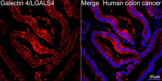 Immunocytochemistry/ Immunofluorescence: Galectin-4 Antibody (9Z2B5) [NBP3-16249] - Confocal imaging of paraffin-embedded Human colon cancer tissue using Galectin-4 Rabbit mAb followed by a further incubation with Cy3 Goat Anti-Rabbit IgG (H+L) . DAPI was used for nuclear staining (Blue). Objective: 40x. Perform high pressure antigen retrieval with 0.01 M citrate buffer (pH 6.0) prior to IF staining.