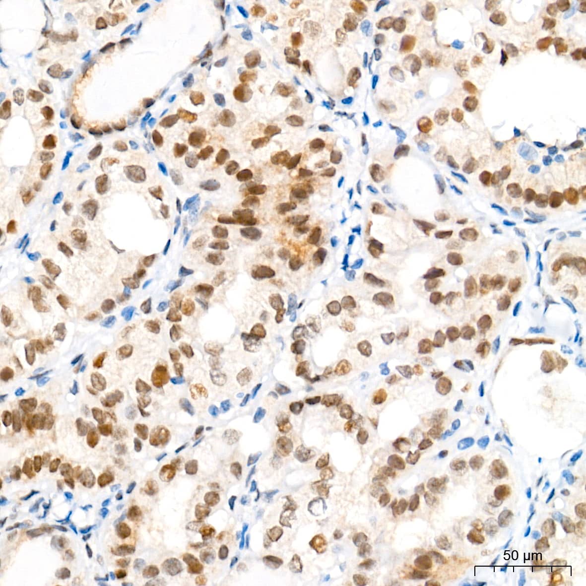 Immunohistochemistry: BANF1 Antibody (6J8O2) [NBP3-16263] - Immunohistochemistry analysis of paraffin-embedded Human thyroid cancer tissue using BANF1 Rabbit mAb at a dilution of 1:500 (40x lens). High pressure antigen retrieval performed with 0.01M Tris-EDTA Buffer (pH 9.0) prior to IHC staining.