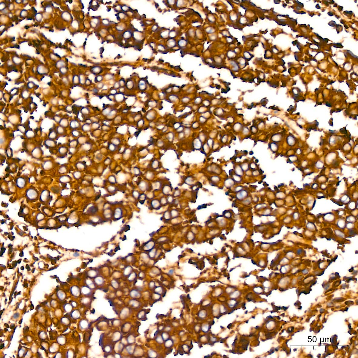 Immunohistochemistry: Filamin A Antibody (3X8Y9) [NBP3-16266] - Immunohistochemistry analysis of paraffin-embedded Human lung squamous carcinoma tissue tissue using Filamin A Rabbit mAb at a dilution of 1:200 (40x lens). High pressure antigen retrieval performed with 0.01M Tris-EDTA Buffer (pH 9.0) prior to IHC staining.