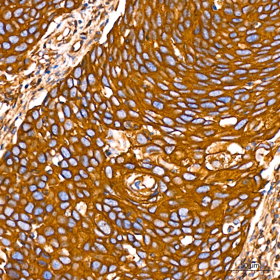 Immunohistochemistry: Filamin A Antibody (3X8Y9) [NBP3-16266] - Immunohistochemistry analysis of paraffin-embedded Human cervix cancer tissue using Filamin A Rabbit mAb at a dilution of 1:400 (40x lens). High pressure antigen retrieval performed with 0.01M Citrate Bufferr (pH 6.0) prior to IHC staining.