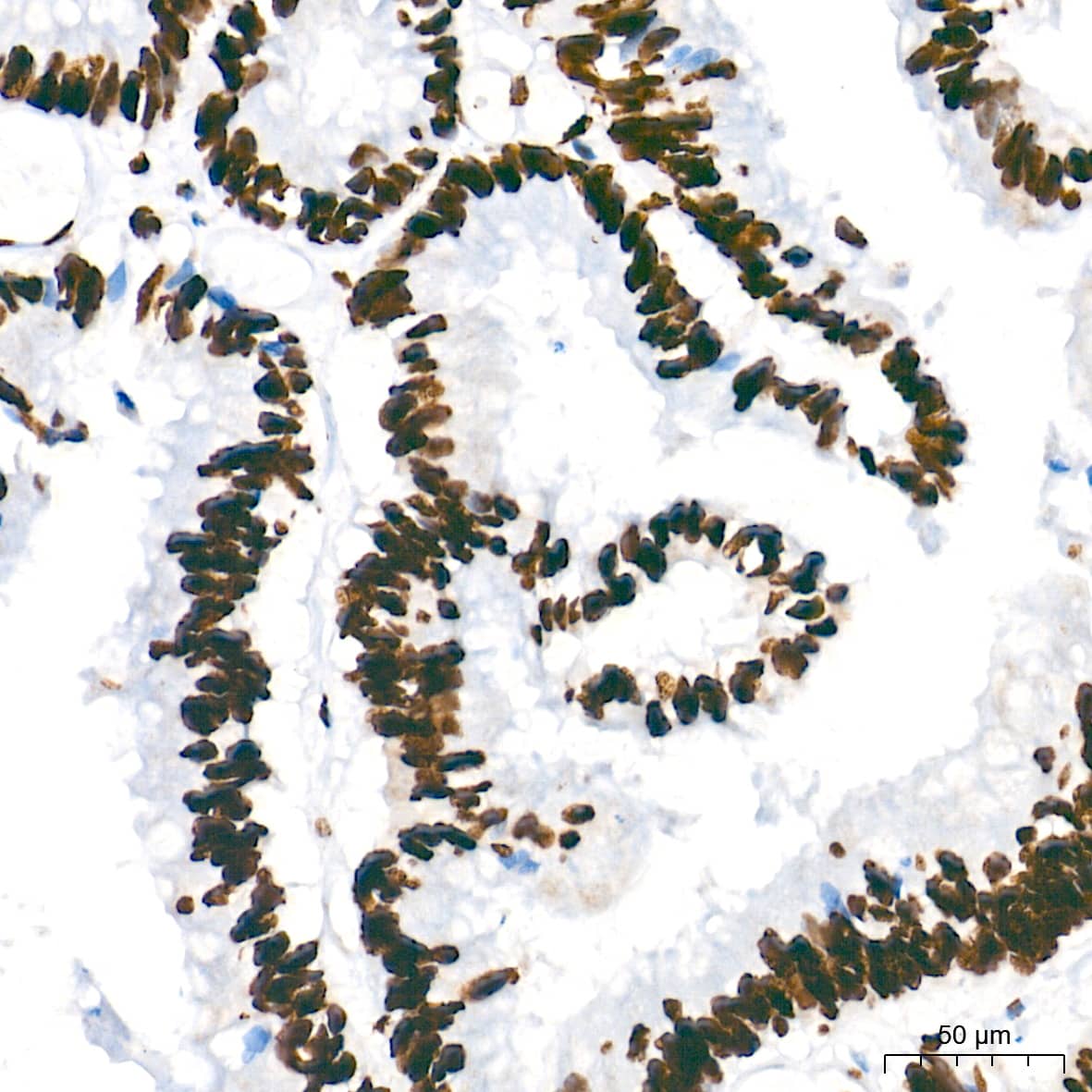 Immunohistochemistry: NONO Antibody (0V0N8) [NBP3-16276] - Immunohistochemistry analysis of paraffin-embedded Human colon carcinoma tissue using NONO Rabbit mAb at a dilution of 1:500 (40x lens). High pressure antigen retrieval performed with 0.01M Tris-EDTA Buffer (pH 9.0) prior to IHC staining.