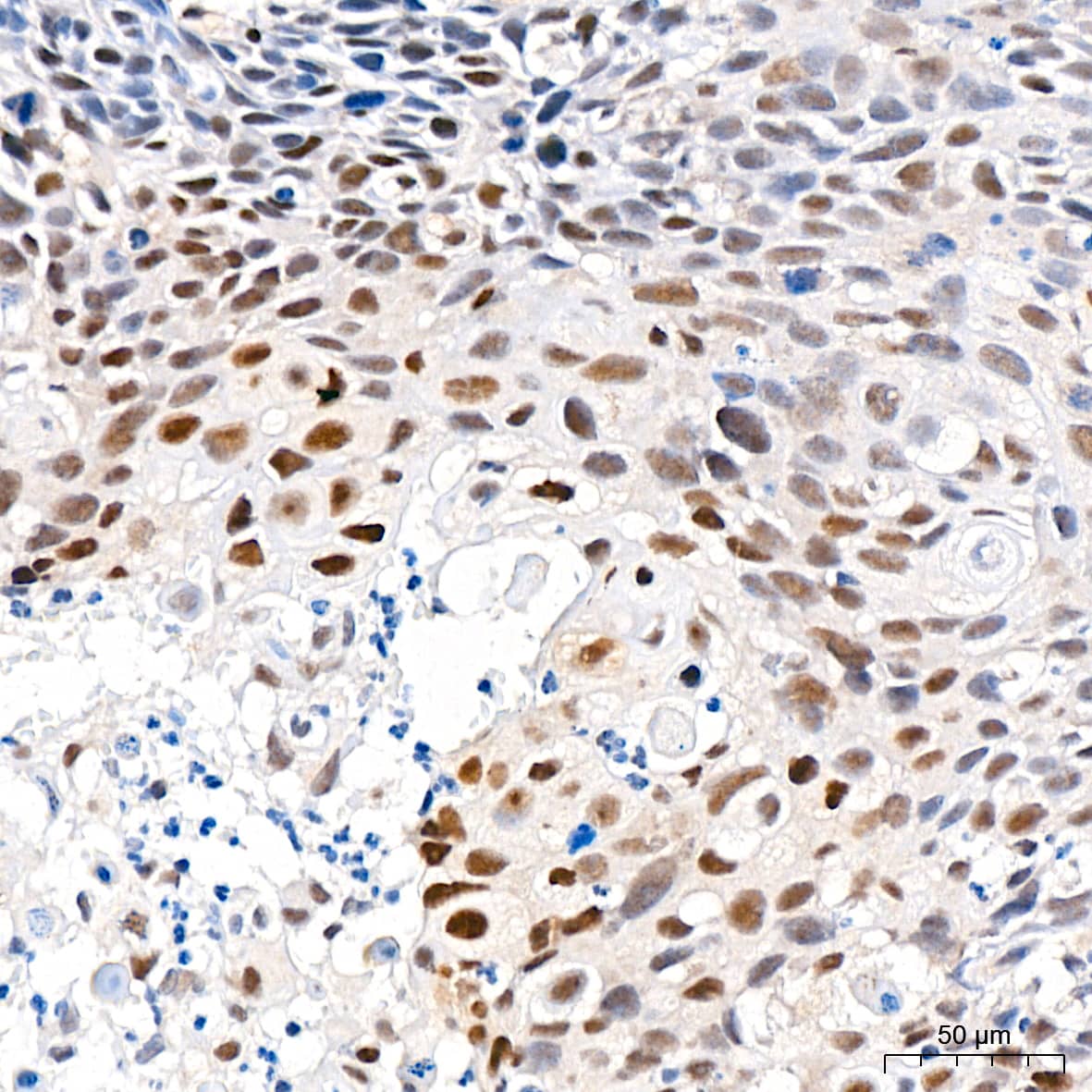 Immunohistochemistry: 6 Phosphofructo 2 Kinase Antibody (7X10D9) [NBP3-16295] - Immunohistochemistry analysis of paraffin-embedded Human cervix cancer tissue using 6 Phosphofructo 2 Kinase Rabbit mAb at a dilution of 1:200 (40x lens). High pressure antigen retrieval performed with 0.01M Citrate Bufferr (pH 6.0) prior to IHC staining.
