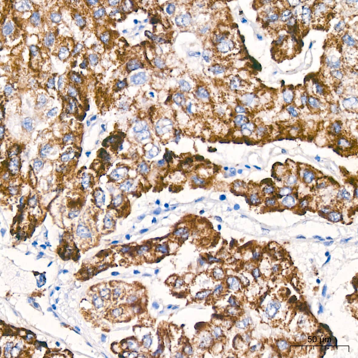 Immunohistochemistry: 6 Phosphofructo 2 Kinase Antibody (7X10D9) [NBP3-16295] - Immunohistochemistry analysis of paraffin-embedded Human liver cancer tissue using 6 Phosphofructo 2 Kinase Rabbit mAb at a dilution of 1:200 (40x lens). High pressure antigen retrieval performed with 0.01M Citrate Bufferr (pH 6.0) prior to IHC staining.