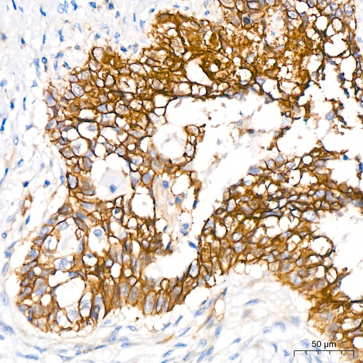 Immunohistochemistry: NDRG1 Antibody (2C6K6) [NBP3-16321] - Immunohistochemistry analysis of NDRG1 in paraffin-embedded human lung squamous carcinoma tissue tissue using NDRG1 Rabbit mAb  at a dilution of 1:200 (40x lens).High pressure antigen retrieval was performed with 0.01 M citrate buffer (pH 6.0) prior to IHC staining.