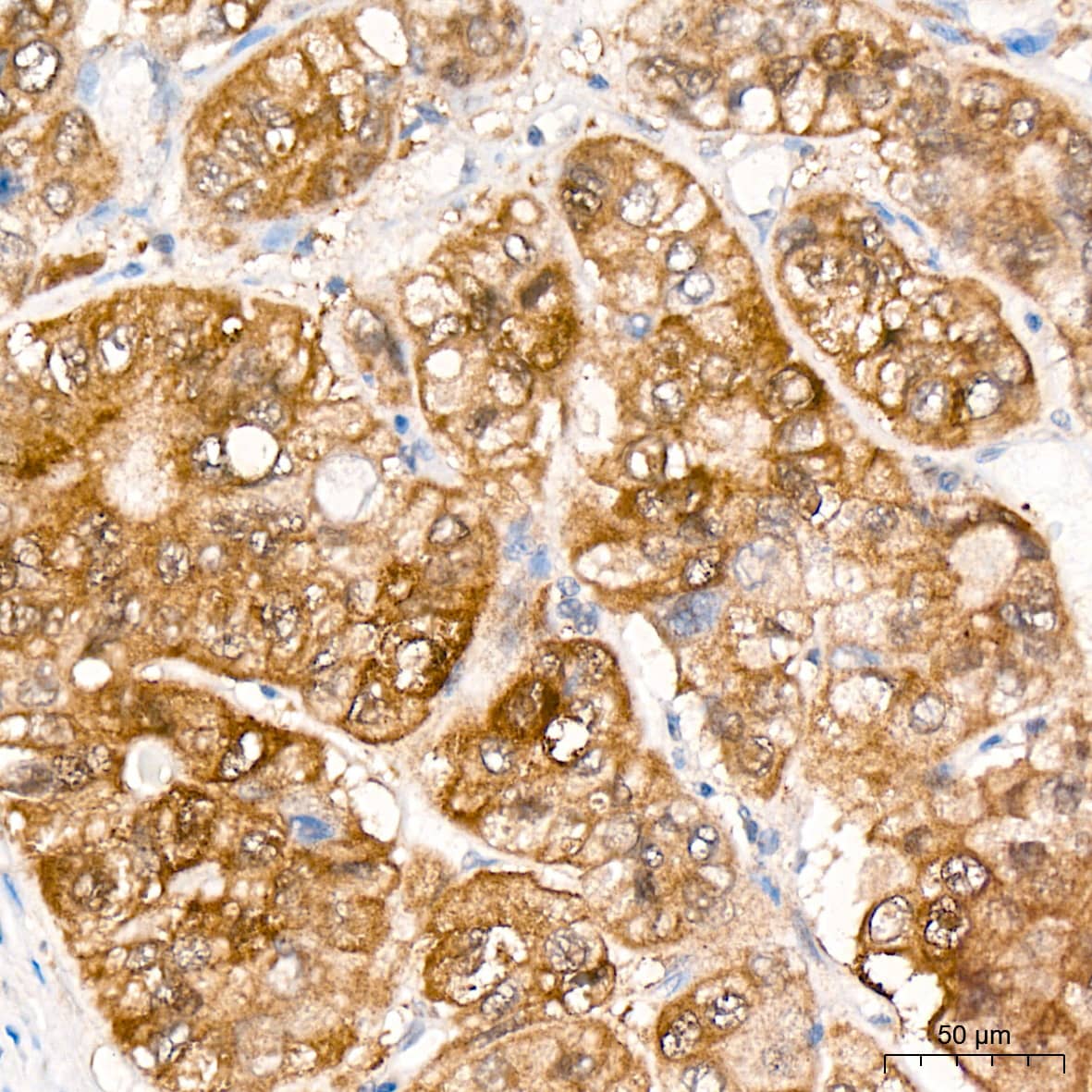 Immunohistochemistry: JAB1 Antibody (3X5F0) [NBP3-16328] - Immunohistochemistry analysis of paraffin-embedded Human liver cancer tissue using JAB1 Rabbit mAb at a dilution of 1:100 (40x lens). High pressure antigen retrieval was performed with 0.01 M citrate buffer (pH 6.0) prior to IHC staining.