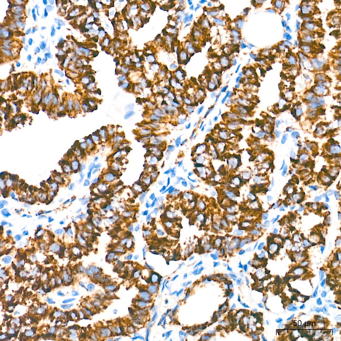 Immunohistochemistry: MAO-A Antibody (9U8P8) [NBP3-16332] - Immunohistochemistry analysis of paraffin-embedded Human thyroid cancer tissue using MAO-A Rabbit mAb at a dilution of 1:2000 (40x lens). High pressure antigen retrieval performed with 0.01M Tris-EDTA Buffer (pH 9.0) prior to IHC staining.