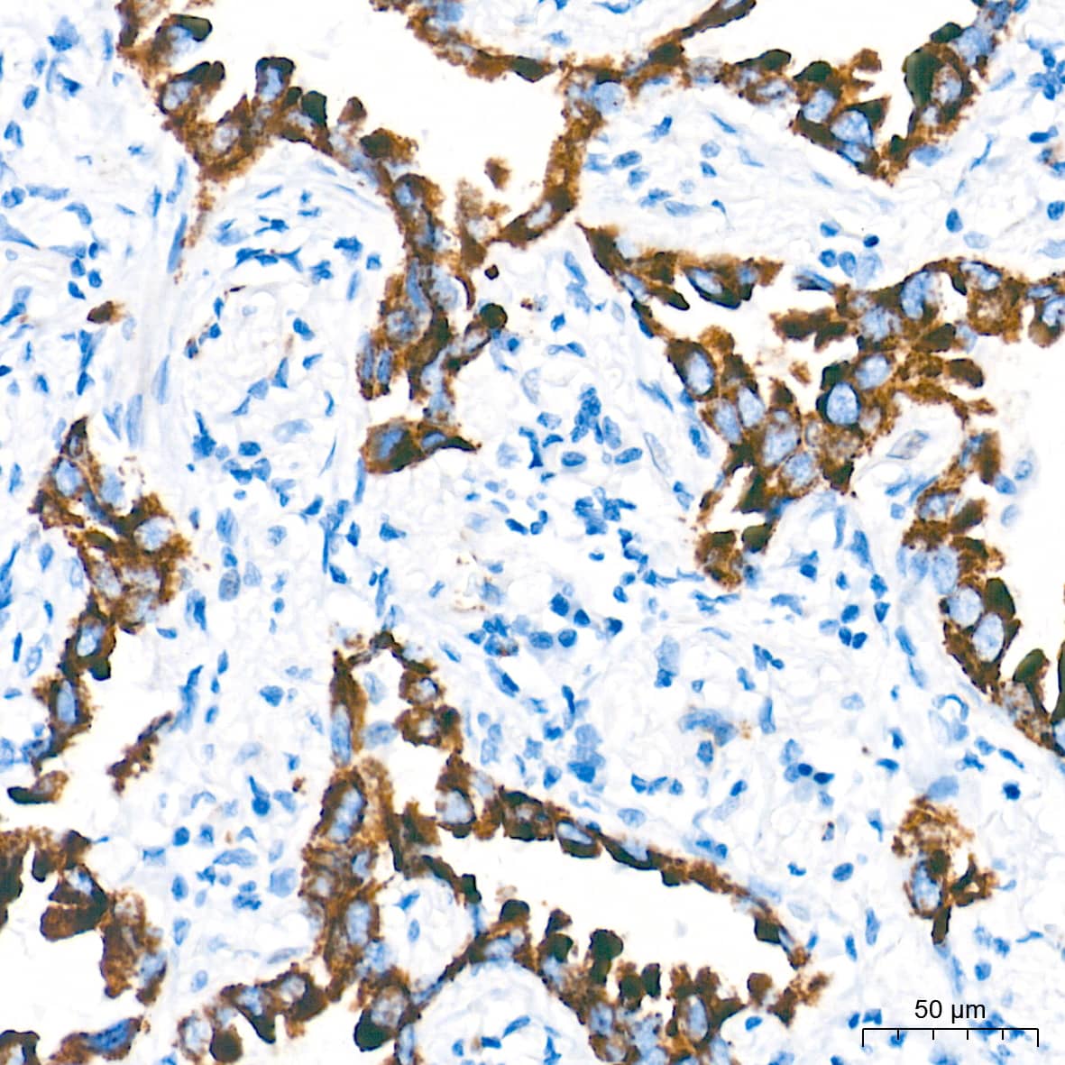 Immunohistochemistry: MAO-A Antibody (9U8P8) [NBP3-16332] - Immunohistochemistry analysis of paraffin-embedded Human lung cancer tissue using MAO-A Rabbit mAb at a dilution of 1:2000 (40x lens). High pressure antigen retrieval performed with 0.01M Tris-EDTA Buffer (pH 9.0) prior to IHC staining.