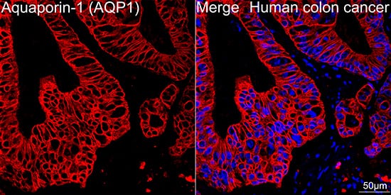 Immunocytochemistry/ Immunofluorescence: Aquaporin 1/AQP1 Antibody (8V1O3) [NBP3-16354] - Confocal imaging of paraffin-embedded Human colon cancer tissue using Aquaporin-1 Rabbit mAb followed by a further incubation with Cy3 Goat Anti-Rabbit IgG (H+L) . DAPI was used for nuclear staining (Blue). High pressure antigen retrieval performed with 0.01M Citrate Buffer (pH 6.0) prior to IF staining. Objective: 40x.