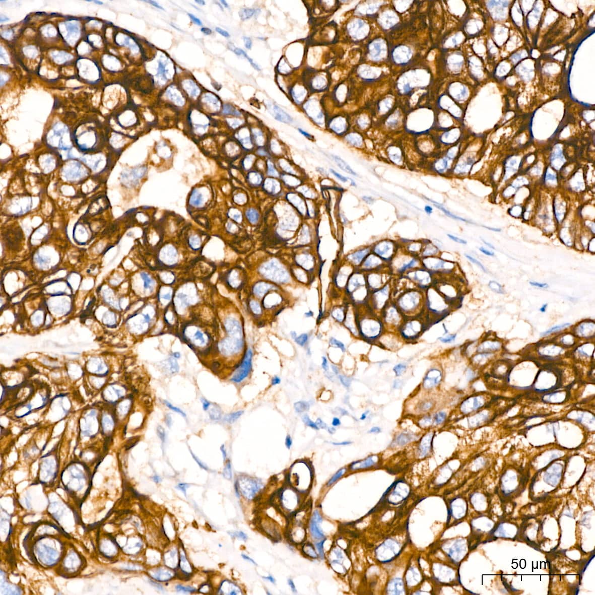 Immunohistochemistry: Aquaporin 1/AQP1 Antibody (8V1O3) [NBP3-16354] - Immunohistochemistry analysis of paraffin-embedded Human colon carcinoma tissue using Aquaporin-1 Rabbit mAb at a dilution of 1:1000 (40x lens). High pressure antigen retrieval performed with 0.01M Citrate Buffer (pH 6.0) prior to IHC staining.