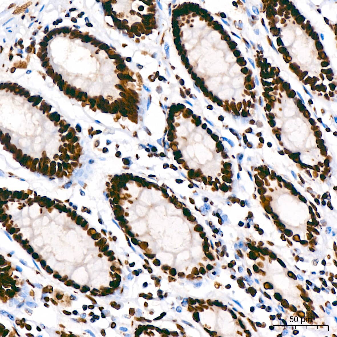 Immunohistochemistry: hnRNP U Antibody (3R3F1) [NBP3-16363] - Immunohistochemistry analysis of paraffin-embedded Human colon using hnRNP U Rabbit mAb at dilution of 1:200 (40x lens). High pressure antigen retrieval performed with 0.01M Citrate Bufferr (pH 6.0) prior to IHC staining.
