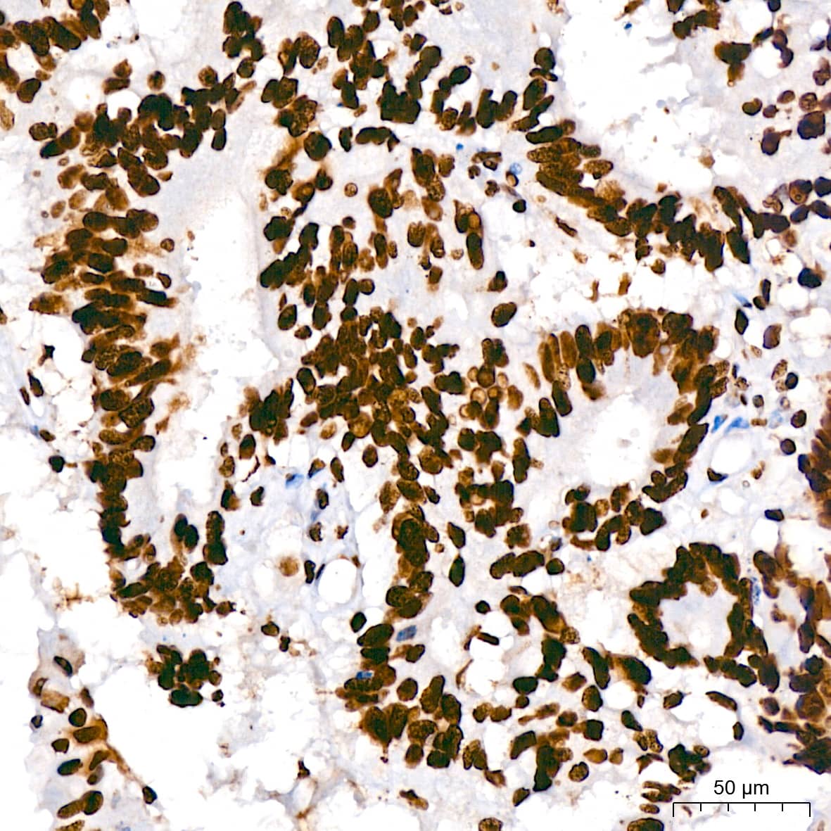 Immunohistochemistry: hnRNP U Antibody (3R3F1) [NBP3-16363] - Immunohistochemistry analysis of paraffin-embedded Human colon carcinoma using hnRNP U Rabbit mAb at dilution of 1:200 (40x lens). High pressure antigen retrieval performed with 0.01M Citrate Bufferr (pH 6.0) prior to IHC staining.