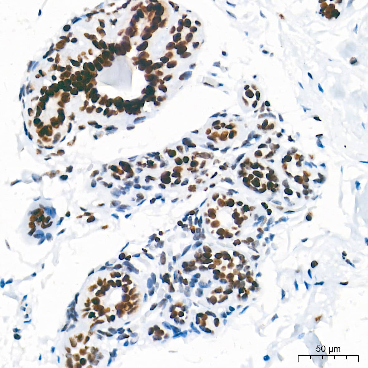 Immunohistochemistry: HMGA1 Antibody (5J0E6) [NBP3-16379] - Immunohistochemistry analysis of paraffin-embedded Human breast tissue using HMGA1 Rabbit mAb at a dilution of 1:5000 (40x lens). High pressure antigen retrieval performed with 0.01M Tris-EDTA Buffer (pH 9.0) prior to IHC staining.