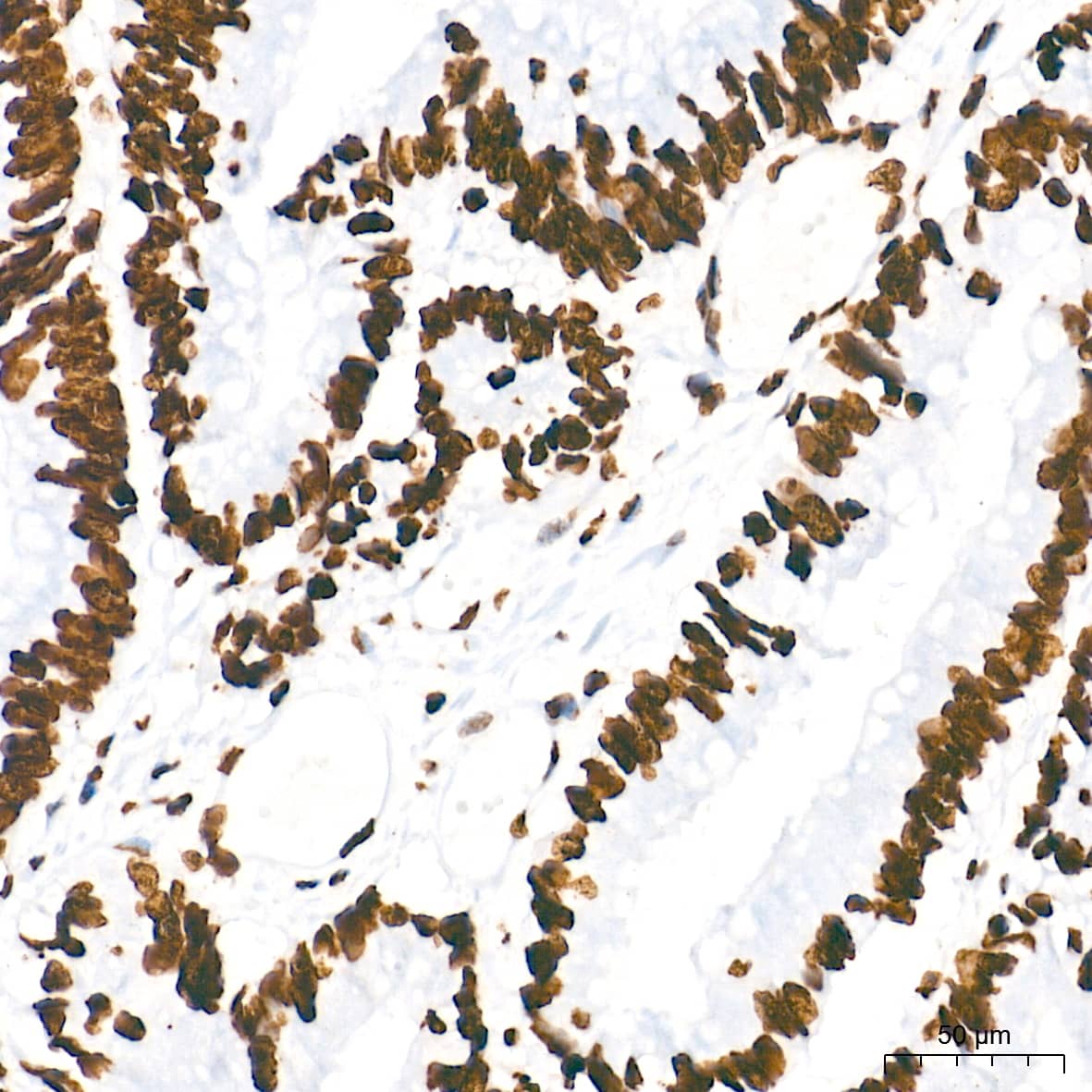 Immunohistochemistry: HMGA1 Antibody (5J0E6) [NBP3-16379] - Immunohistochemistry analysis of paraffin-embedded Human colon carcinoma tissue using HMGA1 Rabbit mAb at a dilution of 1:5000 (40x lens). High pressure antigen retrieval performed with 0.01M Tris-EDTA Buffer (pH 9.0) prior to IHC staining.