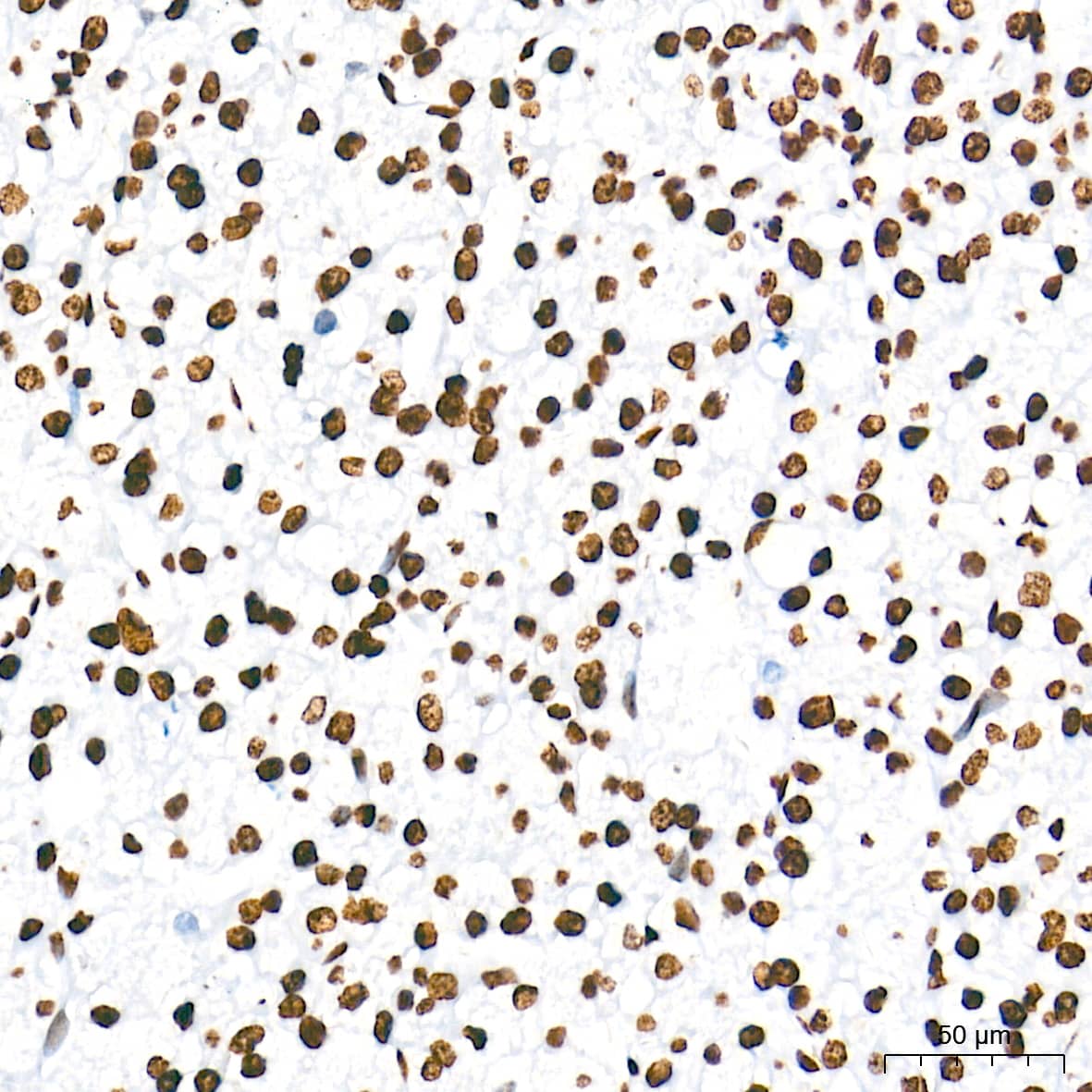 Immunohistochemistry: HMGA1 Antibody (5J0E6) [NBP3-16379] - Immunohistochemistry analysis of paraffin-embedded Human liver cancer tissue using HMGA1 Rabbit mAb at a dilution of 1:5000 (40x lens). High pressure antigen retrieval performed with 0.01M Tris-EDTA Buffer (pH 9.0) prior to IHC staining.
