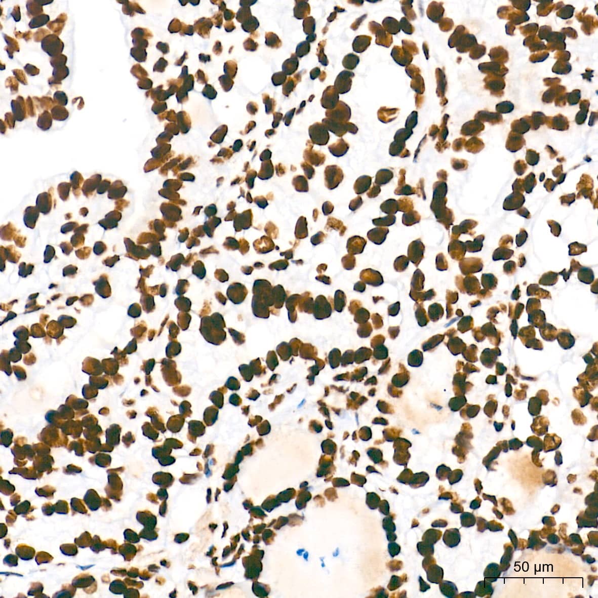 Immunohistochemistry: HMGA1 Antibody (5J0E6) [NBP3-16379] - Immunohistochemistry analysis of paraffin-embedded Human thyroid cancer tissue using HMGA1 Rabbit mAb at a dilution of 1:5000 (40x lens). High pressure antigen retrieval performed with 0.01M Tris-EDTA Buffer (pH 9.0) prior to IHC staining.