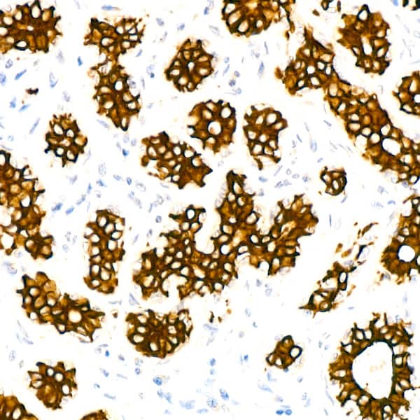 Immunohistochemistry: Cytokeratin 7 Antibody (5V4M10) [NBP3-16388] - Immunohistochemistry analysis of paraffin-embedded Human breast using Cytokeratin 7 Rabbit mAb at dilution of 1:100 (40x lens). Microwave antigen retrieval performed with 0.01M PBS Buffer (pH 7.2) prior to IHC staining.