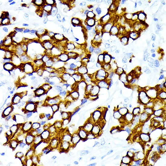 Immunohistochemistry: Cytokeratin 7 Antibody (5V4M10) [NBP3-16388] - Immunohistochemistry analysis of paraffin-embedded Human lung adenocarcinoma using Cytokeratin 7 Rabbit mAb at dilution of 1:100 (40x lens). Microwave antigen retrieval performed with 0.01M PBS Buffer (pH 7.2) prior to IHC staining.