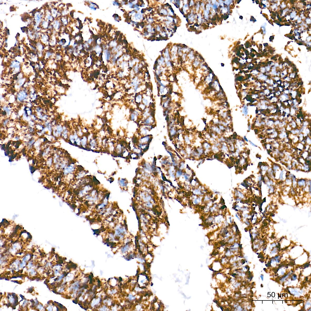 Immunohistochemistry: UQCRC2 Antibody (3E3O8) [NBP3-16390] - Immunohistochemistry analysis of paraffin-embedded Human colon carcinoma tissue using UQCRC2 Rabbit mAb at a dilution of 1:500 (40x lens). High pressure antigen retrieval performed with 0.01M Tris-EDTA Buffer (pH 9.0) prior to IHC staining.