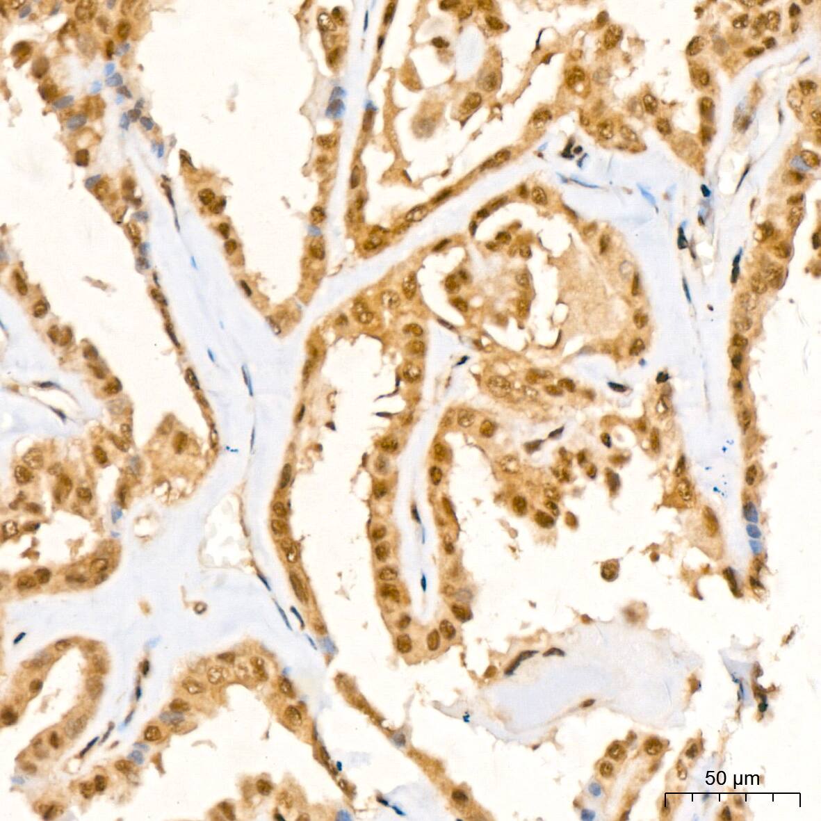Immunohistochemistry: UBE2I/Ubc9 Antibody (6Z9V6) [NBP3-16400] - Immunohistochemistry analysis of UBE2I/Ubc9 in paraffin-embedded human thyroid cancer tissue using UBE2I/Ubc9 Rabbit mAb  at a dilution of 1:200 (40x lens).High pressure antigen retrieval was performed with 0.01 M citrate buffer (pH 6.0) prior to IHC staining.