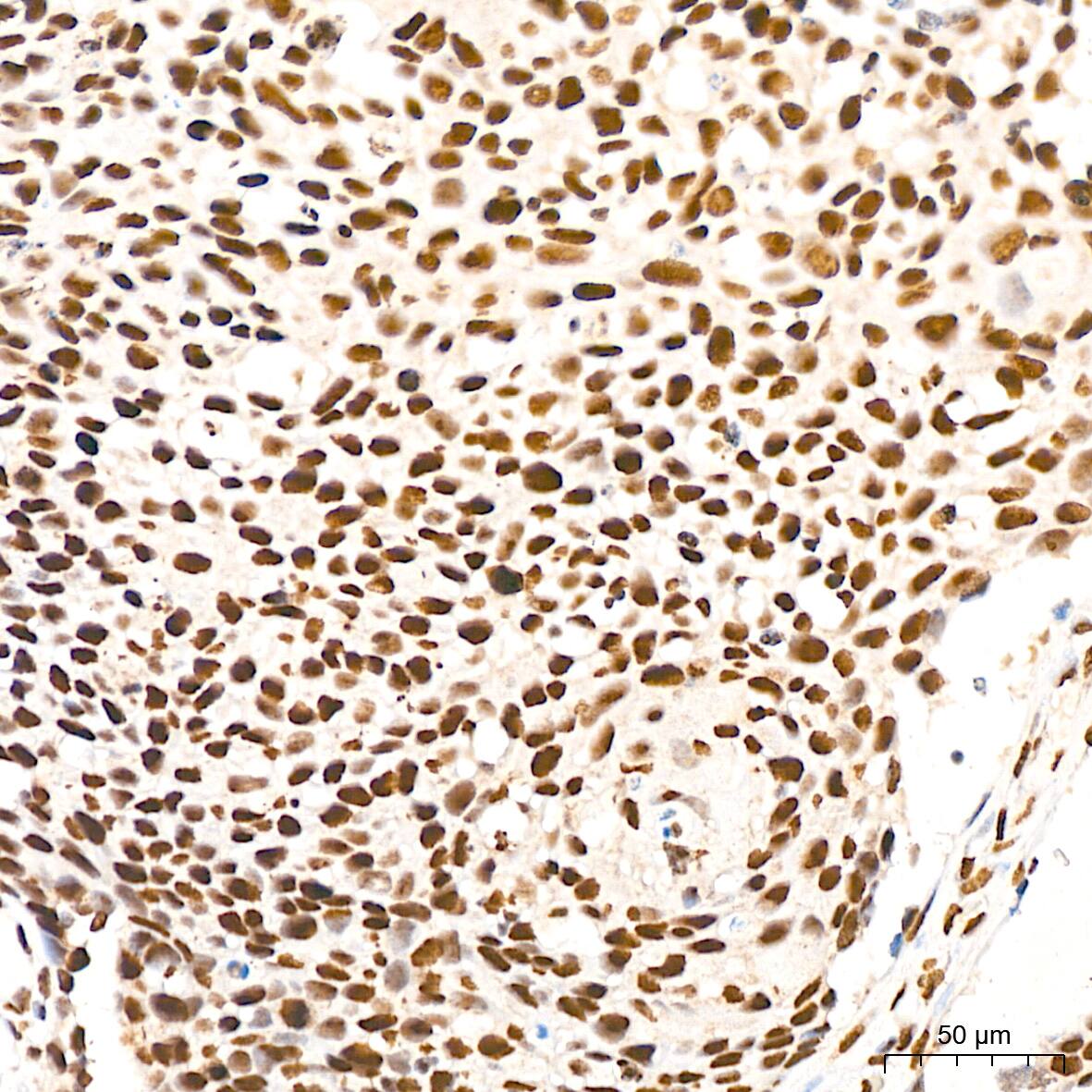 Immunohistochemistry: DKC1 Antibody (2W2V6) [NBP3-16405] - Immunohistochemistry analysis of DKC1 in paraffin-embedded human cervix cancer tissue using DKC1 Rabbit mAb  at a dilution of 1:200 (40x lens). High pressure antigen retrieval was performed with 0.01 M citrate buffer (pH 6.0) prior to IHC staining.